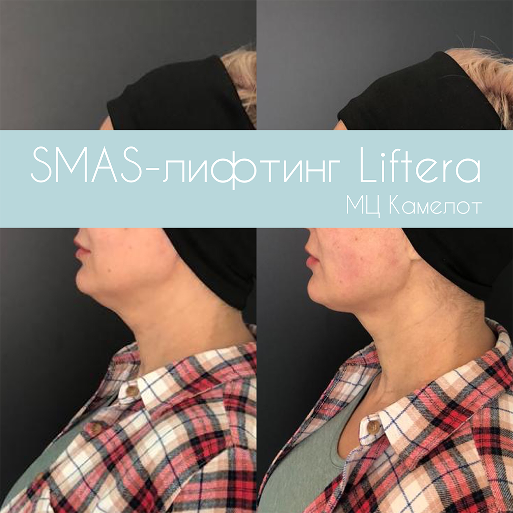SMAS-лифтинг Liftera